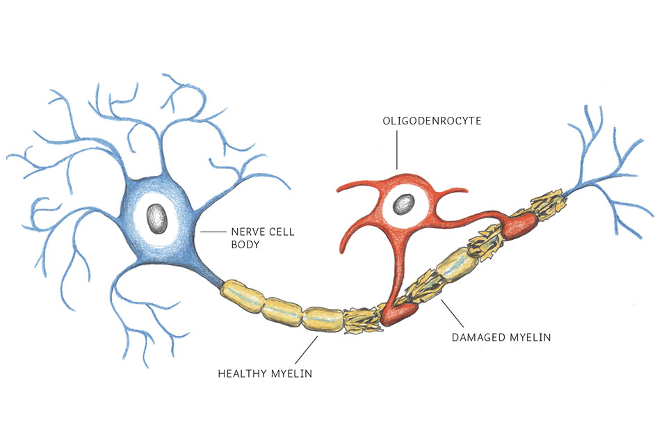 healthy and damaged myelin